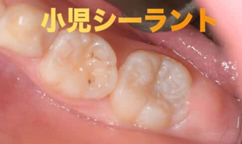 小児虫歯予防フィッシャーシーラント