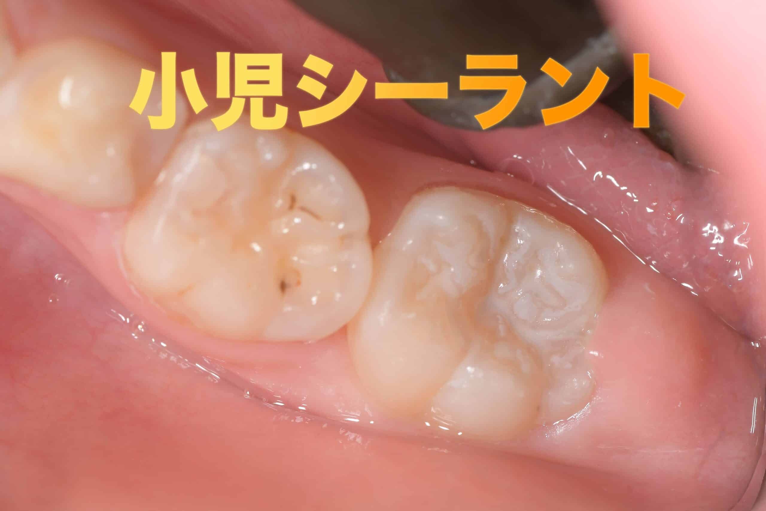 小児虫歯予防フィッシャーシーラント